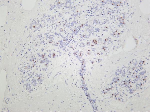 Human breast carcinoma was stained with anti-HNF-3α rabbit antibody