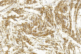 Immunohistochemical analysis of paraffin-embedded Human Melanoma section using Pink1