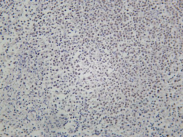 Human melanoma was stained with Anti-MiTF rabbit antibody