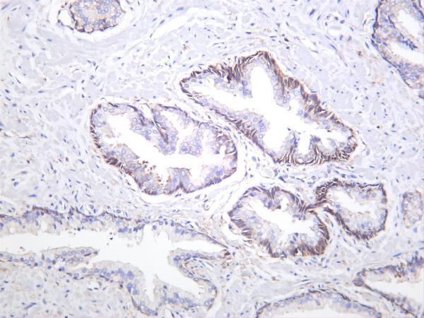 Human prostate carcinoma was stained with anti-NF-κB1 p105/p50 rabbit antibody