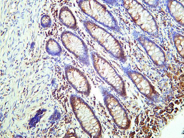 Human colon carcinoma tissue was stained with Anti-SQSTM1/p62 rabbit Antibody
