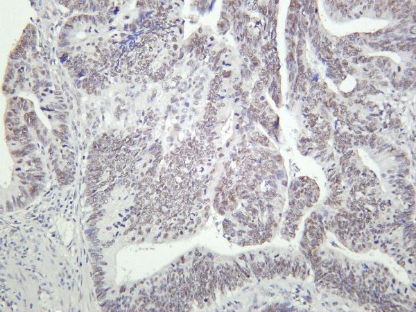 Human colon carcinoma was stained with Anti-TATA Box Binding Protein rabbit antibody