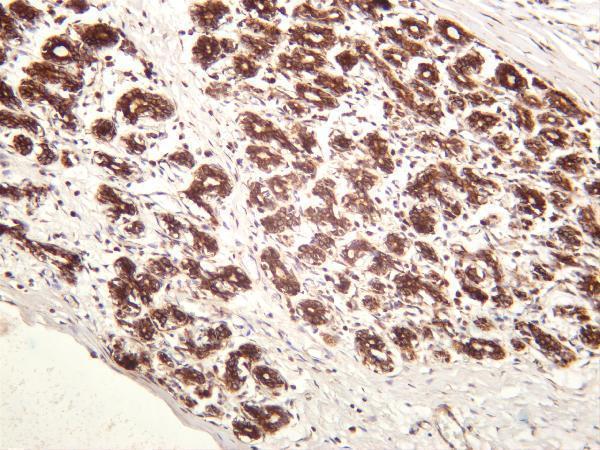 Human breast carcinoma was stained with anti-CHOP rabbit antibody