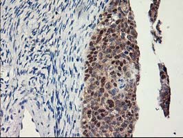 Immunohistochemical staining of paraffin-embedded Adenocarcinoma of Human ovary tissue using anti-LPL mouse monoclonal antibody