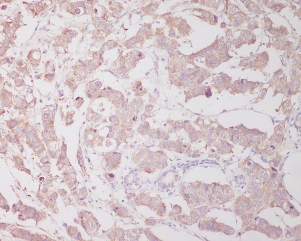 Immunohistochemical analysis of paraffin-embedded human breast cancer, using Beclin 1 Antibody