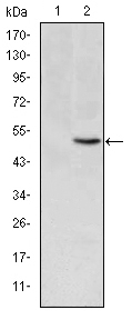 Immunohistochemistry analysis of paraffin-embedded lung cancer tissues with DAB staining using MTHFR Monoclonal Antibody
