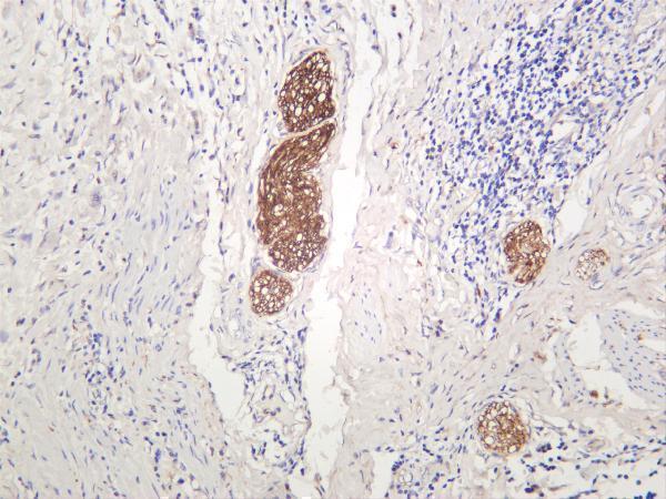 Human cervical carcinoma was stained with anti-ATG7 rabbit antibody