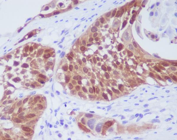 Immunohistochemical analysis of paraffin-embedded human lung cancer, using CDK6 Antibody