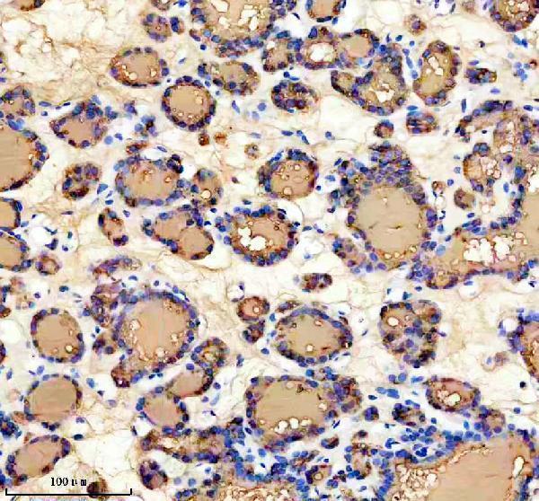 IHC analysis of Thyroglobulin/TG using anti-Thyroglobulin/TG antibody (M00359-3)
