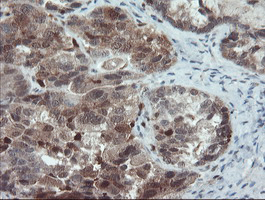 Immunohistochemical staining of paraffin-embedded Adenocarcinoma of Human ovary tissue using anti-PYCARD mouse monoclonal antibody