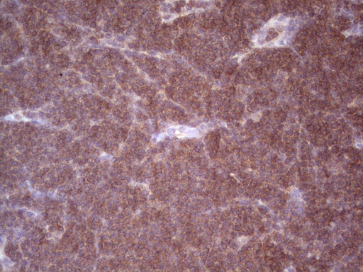 Immunohistochemical staining of paraffin-embedded Human lymphoma tissue using anti-ANGPT2 mouse monoclonal antibody