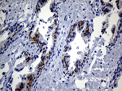 Immunohistochemical staining of paraffin-embedded Carcinoma of Human prostate tissue using anti-EGF mouse monoclonal antibody