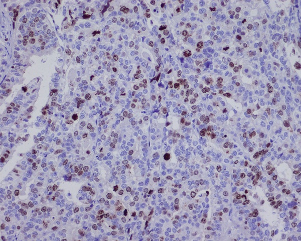 Immunohistochemical analysis of paraffin-embedded mouse ovarian cancer, using Survivin Antibody.