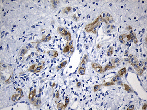 Immunohistochemical staining of paraffin-embedded Carcinoma of Human liver tissue using anti-IL2 mouse monoclonal antibody