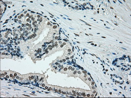 Immunohistochemical staining of paraffin-embedded Carcinoma of prostate tissue using anti-ERCC1 mouse monoclonal antibody