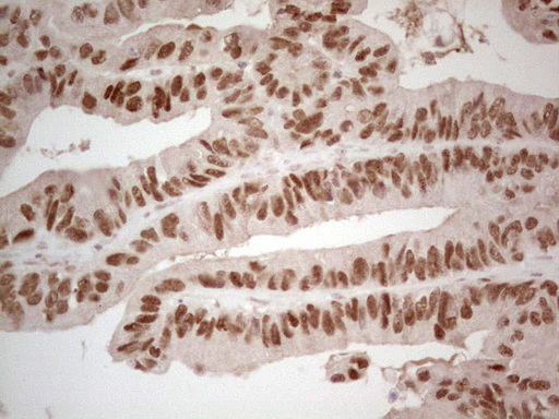 Immunohistochemical staining of paraffin-embedded Adenocarcinoma of Human colon tissue using anti-HNF4A mouse monoclonal antibody