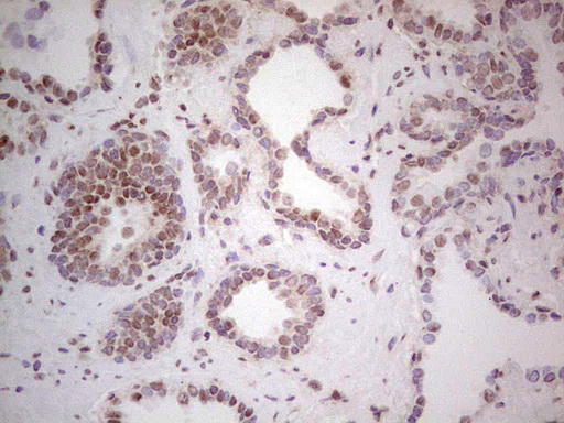 Immunohistochemical staining of paraffin-embedded Carcinoma of Human prostate tissue using anti-RARA mouse monoclonal antibody