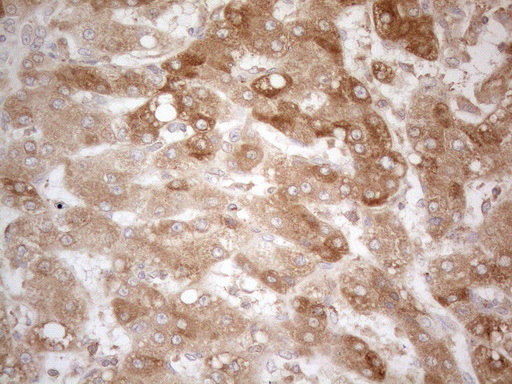 Immunohistochemical staining of paraffin-embedded Carcinoma of Human liver tissue using anti-TNFRSF10B mouse monoclonal antibody