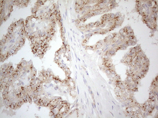 Immunohistochemical staining of paraffin-embedded Carcinoma of Human thyroid tissue using anti-TNFRSF10B mouse monoclonal antibody