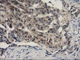 Immunohistochemical staining of paraffin-embedded Carcinoma of Human lung tissue using anti-SPR mouse monoclonal antibody