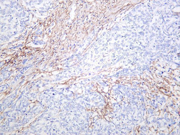 Human breast carcinoma was stained with anti-FAP rabbit antibody