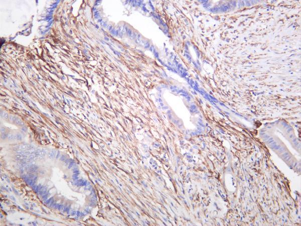 Human colon carcinoma was stained with anti-FAP rabbit antibody