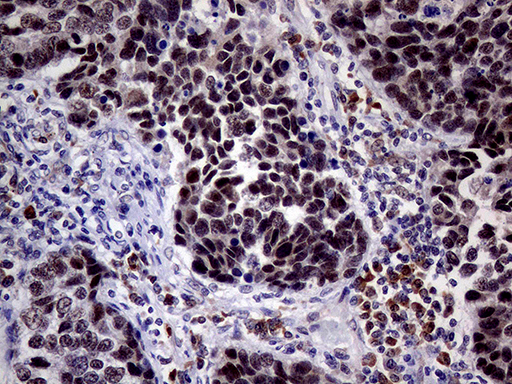 Immunohistochemical staining of paraffin-embedded Carcinoma of Human lung tissue using anti-TOP1 mouse monoclonal antibody