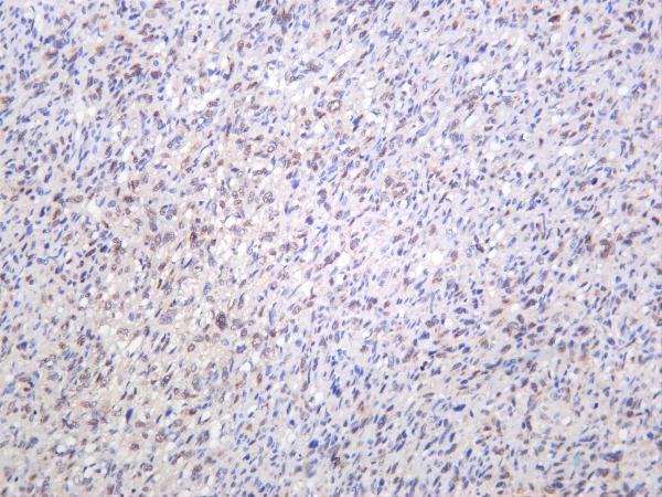 Human osteosarcoma was stained with anti-RUNX2 rabbit antibody
