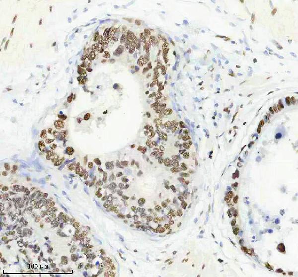 IHC analysis of P-NPM1 using anti-P-NPM1 antibody (M00450S125)