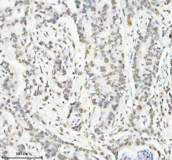 IHC analysis of P-NPM1 using anti-P-NPM1 antibody (M00450S125)