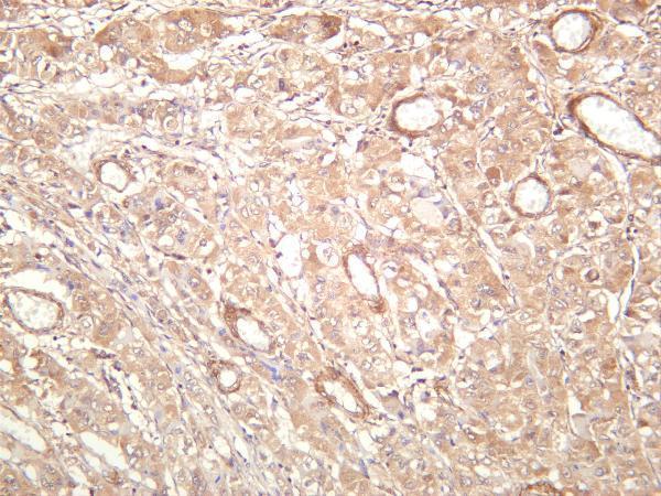 Human hepatocellular carcinoma was stained with anti-PAK1 rabbit antibody