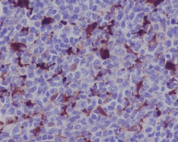 Immunohistochemical analysis of paraffin-embedded human lymphoma, using MERTK Antibody