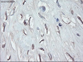 Immunohistochemical staining of paraffin-embedded Carcinoma of Human pancreas tissue using anti-GATA4 mouse monoclonal antibody