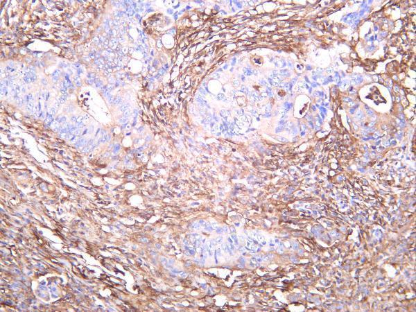 Human colon carcinoma was stained with anti-Filamin A rabbit antibody