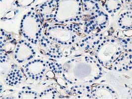 Immunohistochemical staining of paraffin-embedded Carcinoma of Human thyroid tissue using anti-ADIPOQ mouse monoclonal antibody