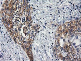 Immunohistochemical staining of paraffin-embedded Carcinoma of Human pancreas tissue using anti-PON1 mouse monoclonal antibody