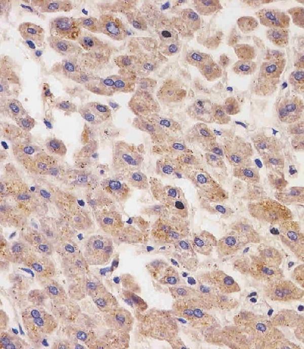 M00522-2 staining AFP in human liver tissue sections by Immunohistochemistry (IHC-P -paraformaldehyde-fixed, paraffin-embedded sections)