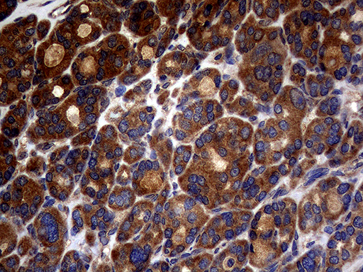 Immunohistochemical staining of paraffin-embedded Carcinoma of Human thyroid tissue using anti-ATG16L1 mouse monoclonal antibody