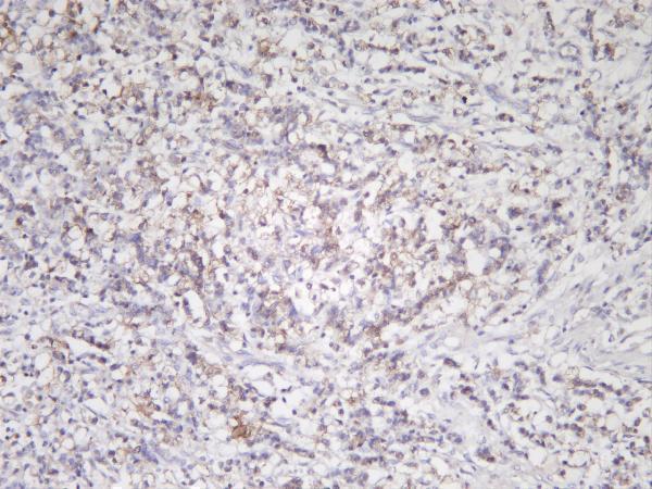 Human gastric carcinoma was stained with anti-VEGF Receptor 1 rabbit antibody