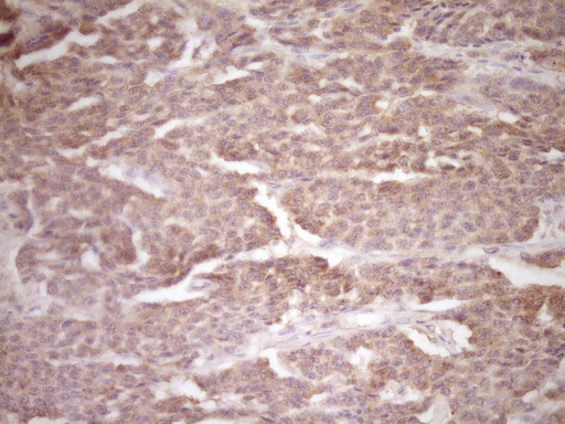 Immunohistochemical staining of paraffin-embedded Carcinoma of Human lung tissue using anti-ERBB3 mouse monoclonal antibody