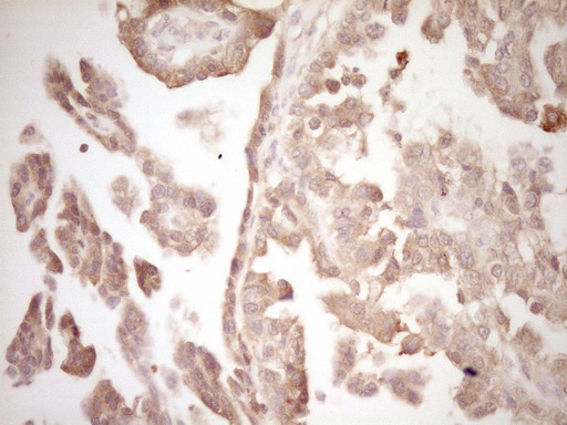 Immunohistochemical staining of paraffin-embedded Adenocarcinoma of Human ovary tissue using anti-ERBB3 mouse monoclonal antibody