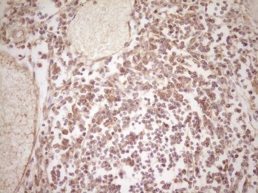 Immunohistochemical staining of paraffin-embedded Human thyroid tissue within the normal limits using anti-ERBB3 mouse monoclonal antibody