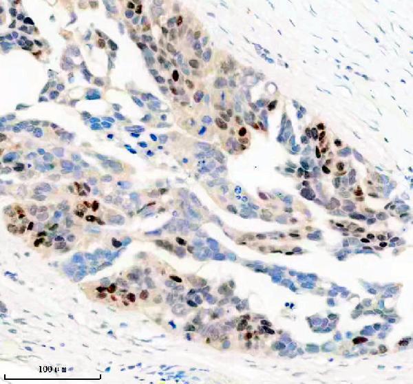 IHC analysis of PGR using anti-PGR antibody (M00541-1)