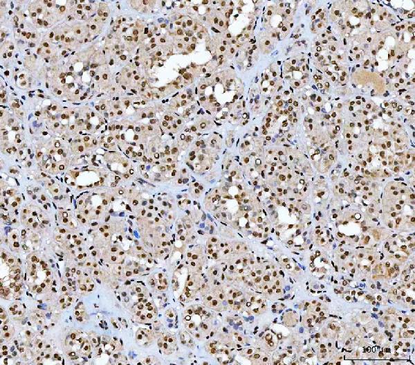  IHC analysis of AREB6/ZEB1 using anti-AREB6/ZEB1 antibody (M00548-2)