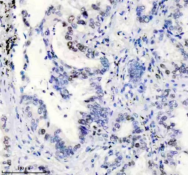 IHC analysis of MSH6 using anti-MSH6 antibody (M00553)