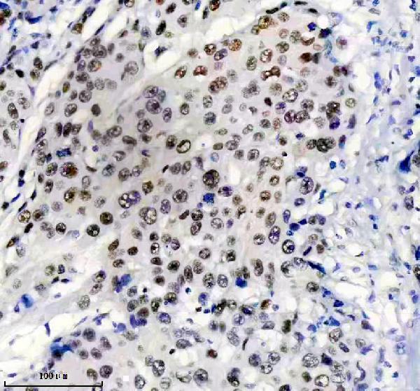 IHC analysis of MSH6 using anti-MSH6 antibody (M00553)