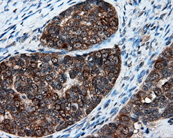Immunohistochemical staining of paraffin-embedded Adenocarcinoma of Human ovary tissue using anti-XRCC1 mouse monoclonal antibody