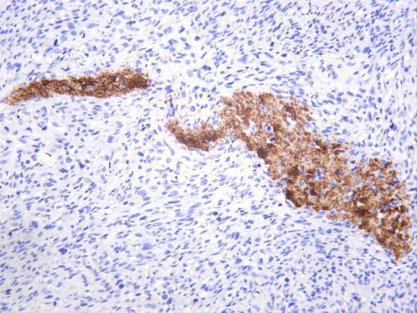 Human osteosarcomas was stained with anti-Integrin β3 rabbit antibody
