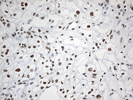 Immunohistochemical staining of paraffin-embedded Carcinoma of Human kidney tissue using anti-EWSR1 mouse monoclonal antibody
