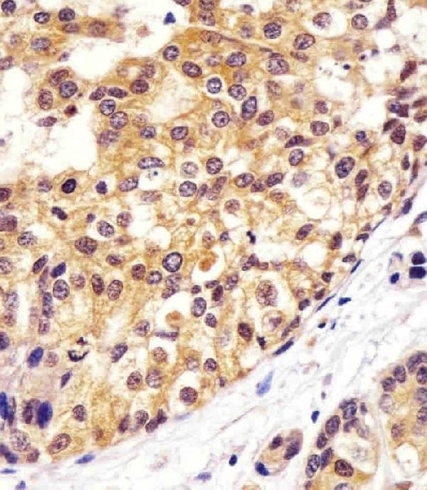 M00610-1 staining VCP in human breast carcinoma sections by Immunohistochemistry (IHC-P -paraformaldehyde-fixed, paraffin-embedded sections)